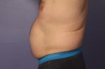 CoolSculpting Before and After Photo