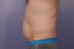 CoolSculpting Before and After Photo