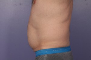 CoolSculpting Before and After