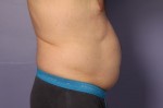 CoolSculpting Before and After Photo