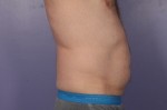 CoolSculpting Before and After Photo