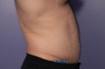 CoolSculpting Before and After Photo