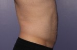 CoolSculpting Before and After Photo