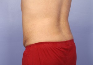 Liposuction Before and After