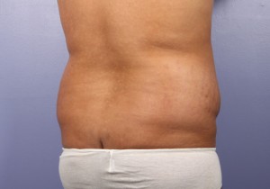 Liposuction Before and After