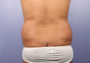 Liposuction Before and After