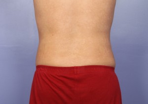 Liposuction Before and After