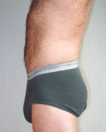 Liposuction Before and After Photo