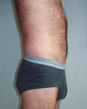 Liposuction Before and After