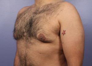 Liposuction Before and After