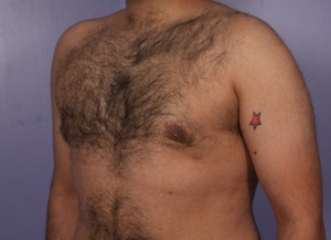 Liposuction Before and After