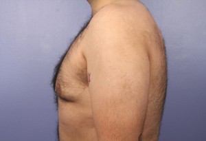 Liposuction Before and After