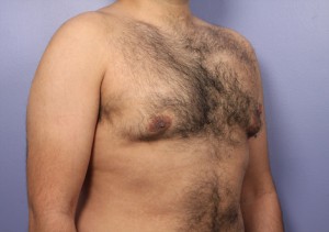 Liposuction Before and After