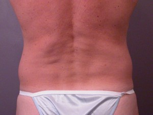 Liposuction Before and After