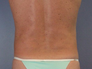 Liposuction Before and After