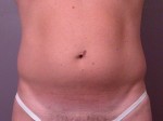 Liposuction Before and After Photo