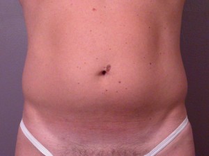 Liposuction Before and After