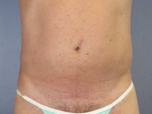 Liposuction Before and After