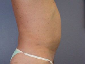 Liposuction Before and After