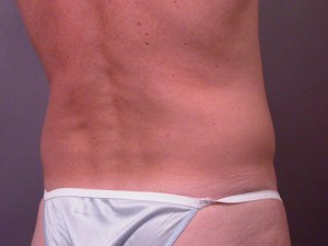 Liposuction Before and After