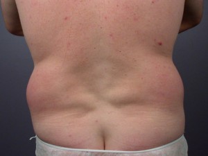 Liposuction Before and After