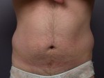 Liposuction Before and After Photo