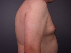 Liposuction Before and After