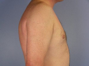 Liposuction Before and After