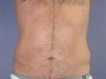 Liposuction Before and After Photo