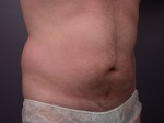 Liposuction Before and After Photo