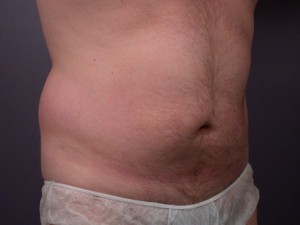 Liposuction Before and After