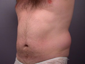 Liposuction Before and After