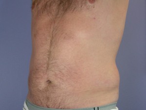 Liposuction Before and After