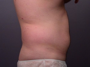 Liposuction Before and After