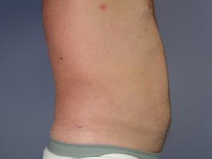 Liposuction Before and After