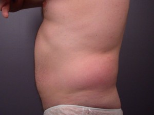 Liposuction Before and After