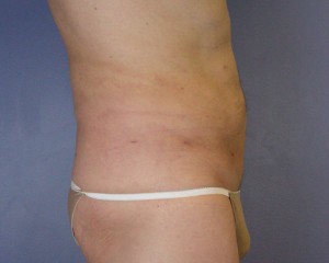 Liposuction Before and After