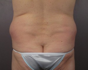 Liposuction Before and After