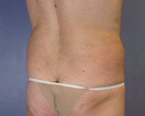 Liposuction Before and After