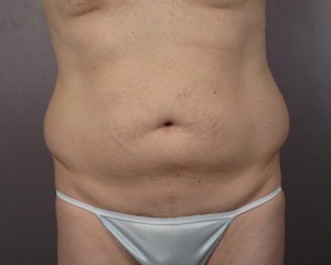 Liposuction Before and After