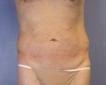 Liposuction Before and After Photo