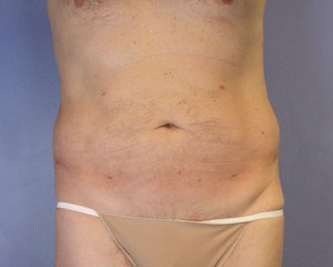 Liposuction Before and After