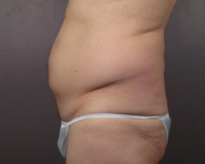 Liposuction Before and After