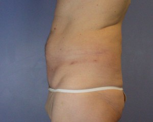 Liposuction Before and After