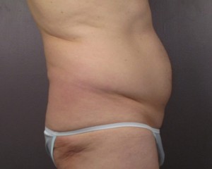 Liposuction Before and After