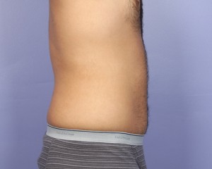 Liposuction Before and After