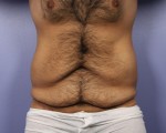 Liposuction Before and After Photo