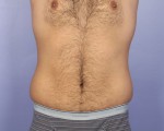 Liposuction Before and After Photo