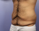 Liposuction Before and After Photo