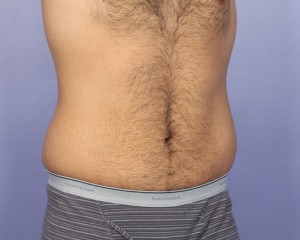 Liposuction Before and After